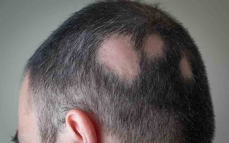 alopecia-areata-in-dubai
